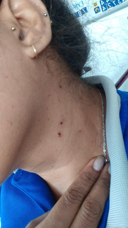 crema elimina verrugas lunares y mezquinos