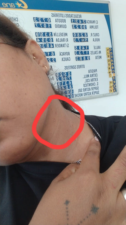 crema elimina verrugas lunares y mezquinos