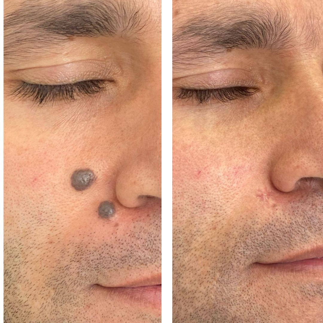 crema elimina verrugas lunares y mezquinos