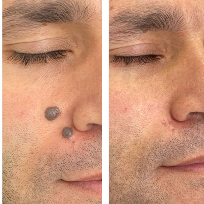 crema elimina verrugas lunares y mezquinos