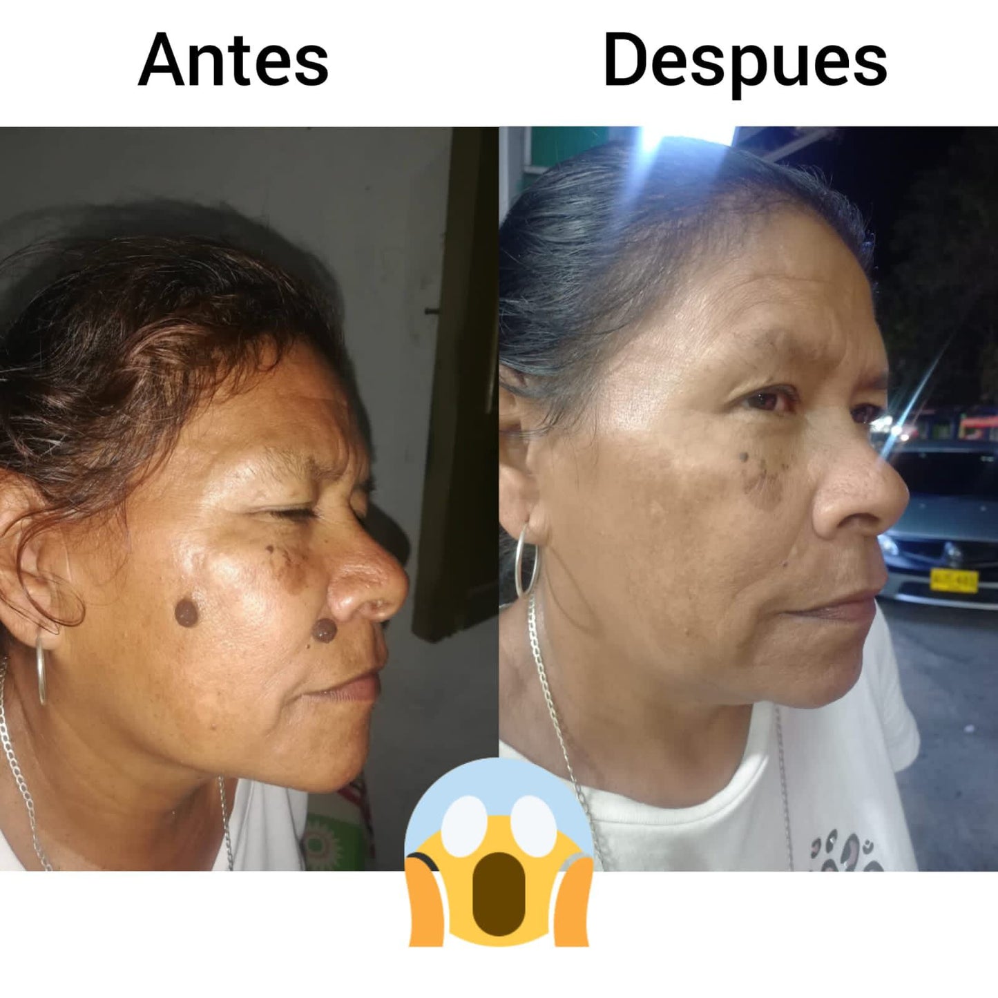 crema elimina verrugas lunares y mezquinos